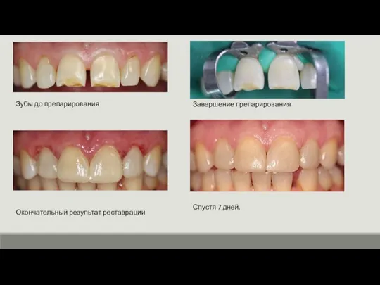 Зубы до препарирования Завершение препарирования Окончательный результат реставрации Спустя 7 дней.