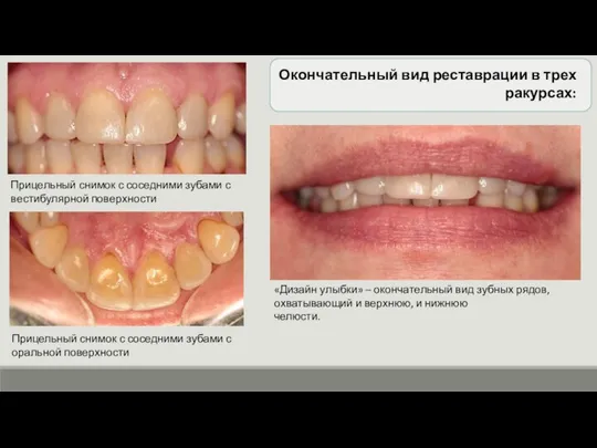«Дизайн улыбки» – окончательный вид зубных рядов, охватывающий и верхнюю, и нижнюю
