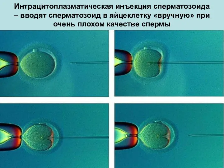 Интрацитоплазматическая инъекция сперматозоида – вводят сперматозоид в яйцеклетку «вручную» при очень плохом качестве спермы