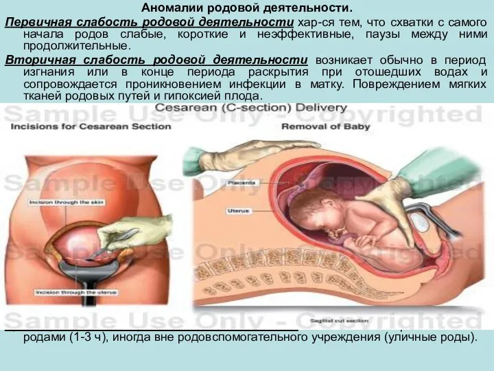 Аномалии родовой деятельности. Первичная слабость родовой деятельности хар-ся тем, что схватки с