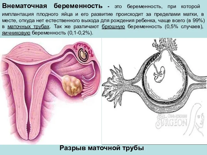 Внематочная беременность - это беременность, при которой имплантация плодного яйца и его