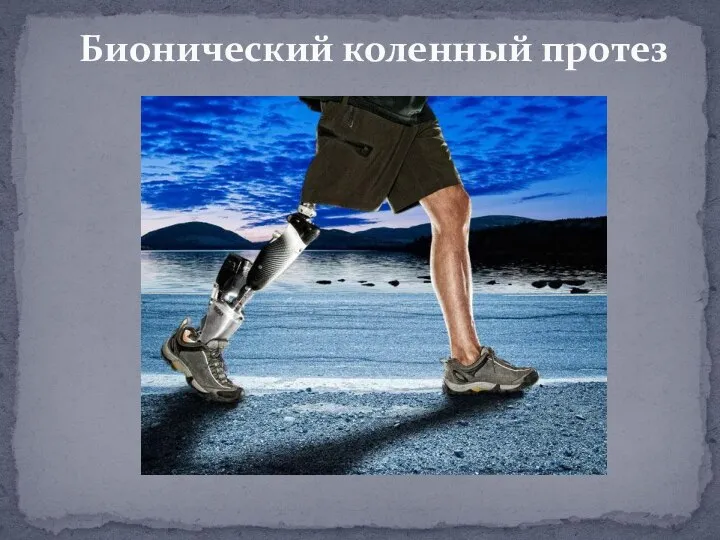 Бионический коленный протез