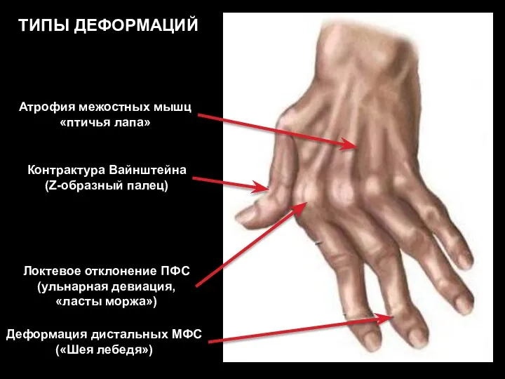 Контрактура Вайнштейна (Z-образный палец) Локтевое отклонение ПФС (ульнарная девиация, «ласты моржа») Деформация