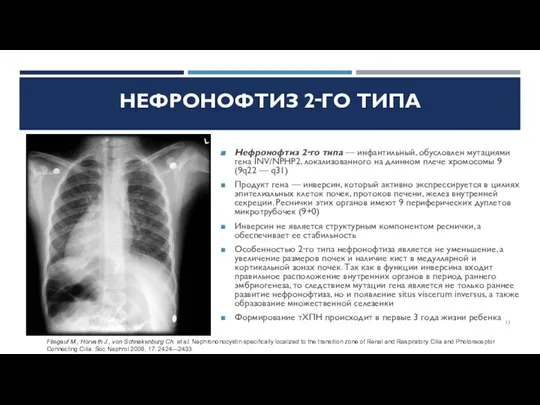 НЕФРОНОФТИЗ 2‑ГО ТИПА Нефронофтиз 2‑го типа — инфантильный, обусловлен мутациями гена INV/NPHP2,