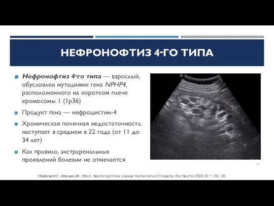 НЕФРОНОФТИЗ 4‑ГО ТИПА Нефронофтиз 4‑го типа — взрослый, обусловлен мутациями гена NPHP4,