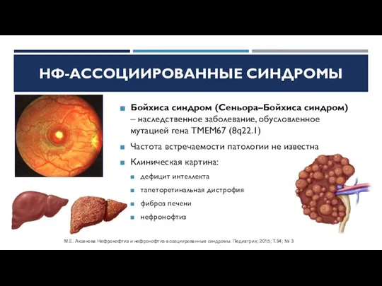 Бойхиса синдром (Сеньора–Бойхиса синдром) – наследственное заболевание, обусловленное мутацией гена TMEM67 (8q22.1)