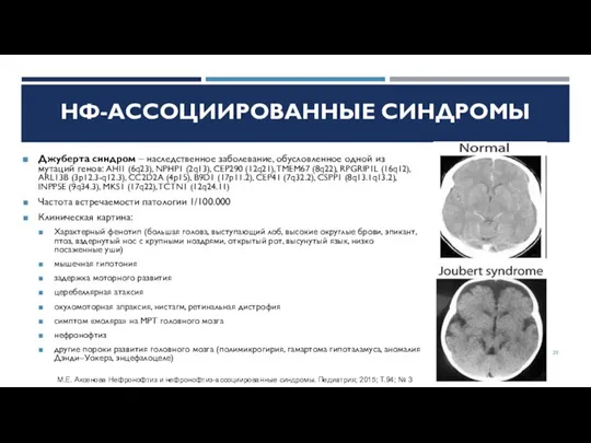 Джуберта синдром – наследственное заболевание, обусловленное одной из мутаций генов: AHI1 (6q23),