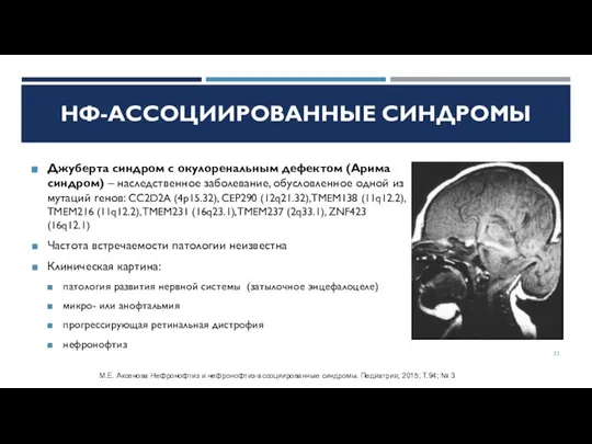 Джуберта синдром с окулоренальным дефектом (Арима синдром) – наследственное заболевание, обусловленное одной