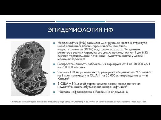 ЭПИДЕМИОЛОГИЯ НФ Нефронофтиз (НФ) занимает лидирующее место в структуре наследственных причин хронической