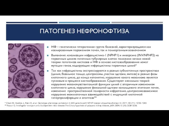 ПАТОГЕНЕЗ НЕФРОНОФТИЗА НФ – генетически гетерогенная группа болезней, характеризующаяся как изолированным поражением