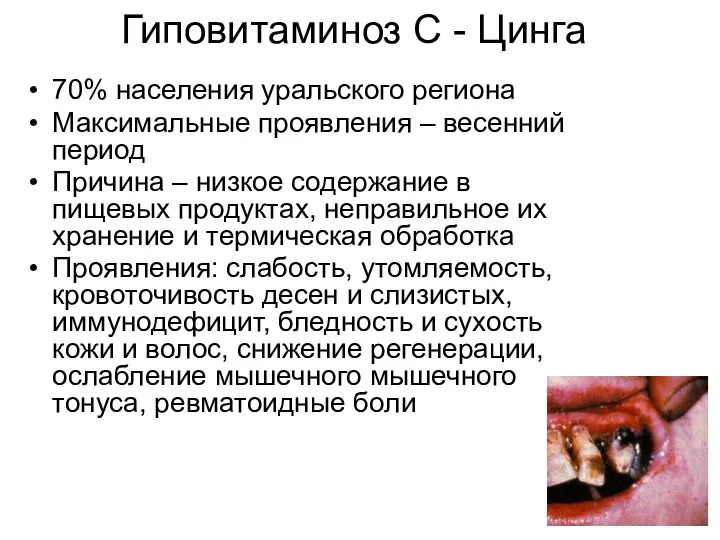 Гиповитаминоз С - Цинга 70% населения уральского региона Максимальные проявления – весенний