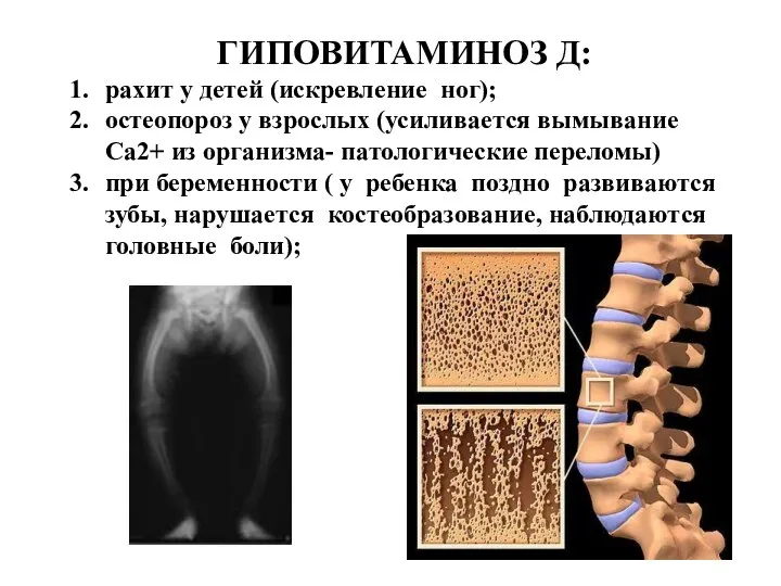 ГИПОВИТАМИНОЗ Д: рахит у детей (искревление ног); остеопороз у взрослых (усиливается вымывание