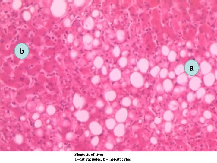 Steatosis of liver а –fat vacuoles, b – hepatocytes