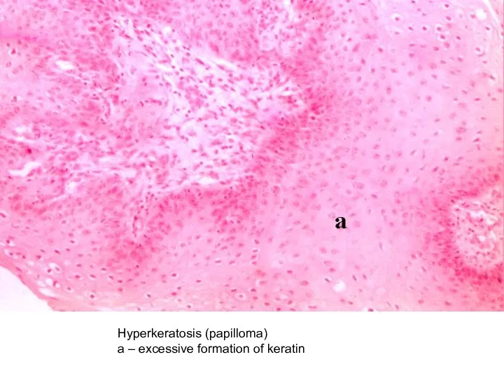 Hyperkeratosis (papilloma) а – excessive formation of keratin