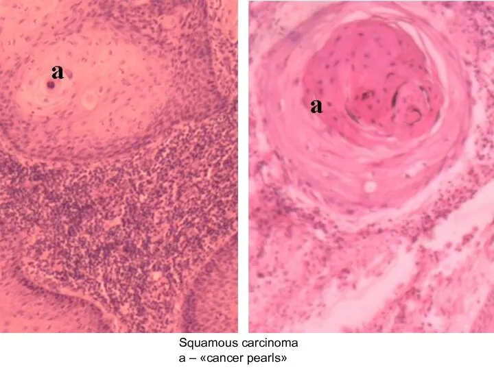 Squamous carcinoma а – «cancer pearls»