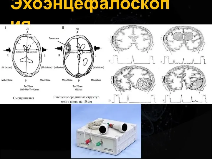 Эхоэнцефалоскопия