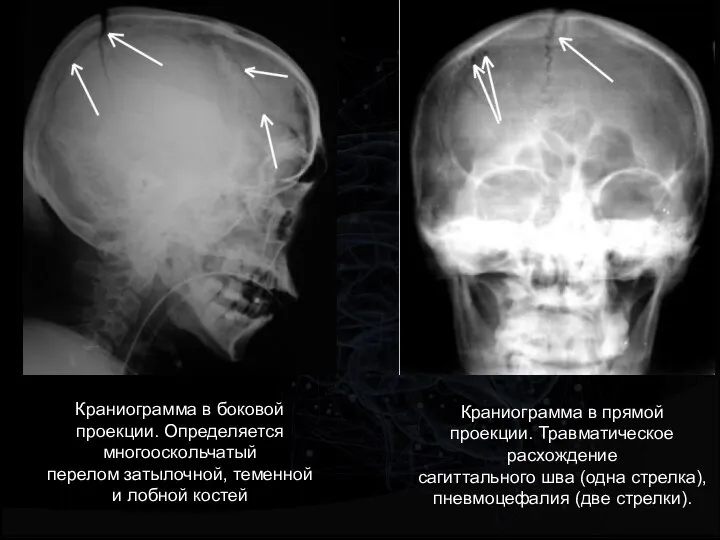 Краниограмма в боковой проекции. Определяется многооскольчатый перелом затылочной, теменной и лобной костей