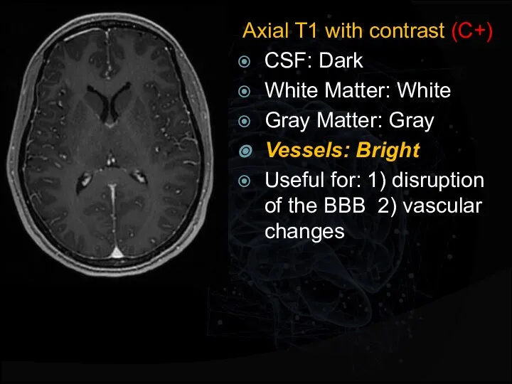 Axial T1 with contrast (C+) CSF: Dark White Matter: White Gray Matter: