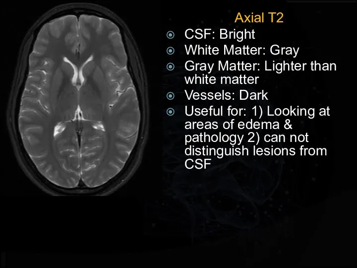 Axial T2 CSF: Bright White Matter: Gray Gray Matter: Lighter than white