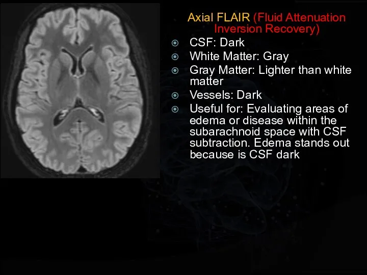 Axial FLAIR (Fluid Attenuation Inversion Recovery) CSF: Dark White Matter: Gray Gray