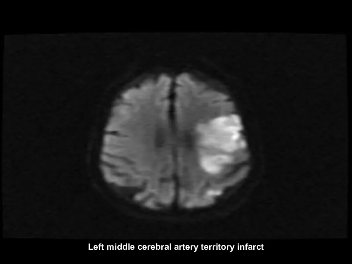 Left middle cerebral artery territory infarct