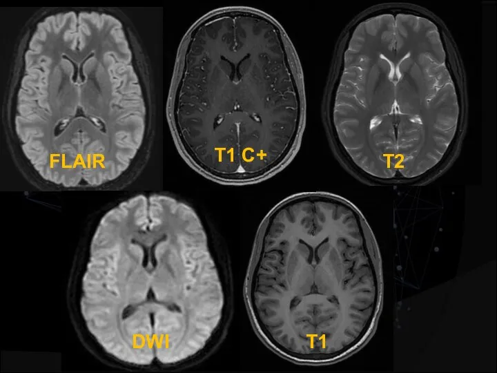 FLAIR T1 С+ T1 Т2 DWI