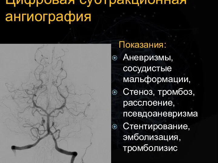 Цифровая субтракционная ангиография Показания: Аневризмы, сосудистые мальформации, Стеноз, тромбоз, расслоение, псевдоаневризма Стентирование, эмболизация, тромболизис