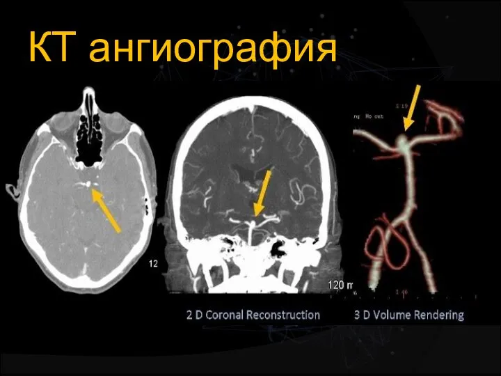 КТ ангиография