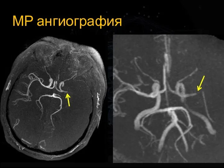 МР ангиография