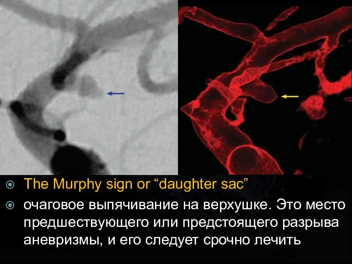 The Murphy sign or “daughter sac” очаговое выпячивание на верхушке. Это место