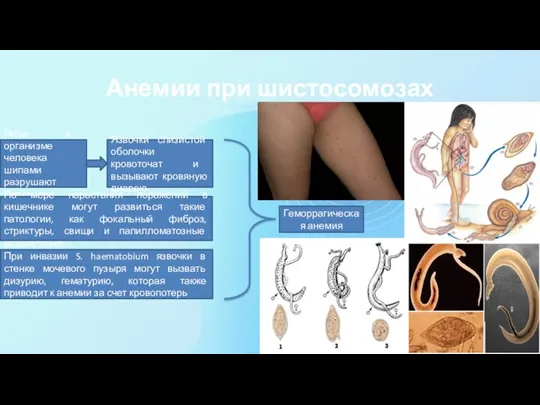 Анемии при шистосомозах Яйца в организме человека шипами разрушают ткани Язвочки слизистой