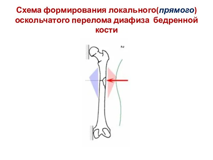 Схема формирования локального(прямого) оскольчатого перелома диафиза бедренной кости