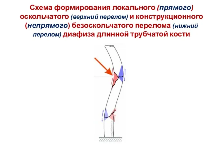 Схема формирования локального (прямого) оскольчатого (верхний перелом) и конструкционного (непрямого) безоскольчатого перелома