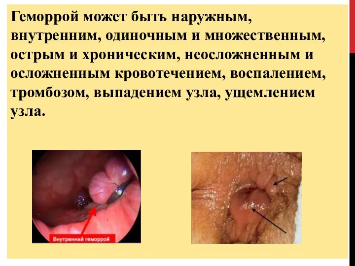 Геморрой может быть наружным, внутренним, одиночным и множественным, острым и хроническим, неосложненным