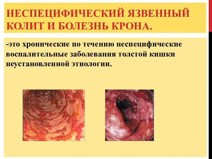 НЕСПЕЦИФИЧЕСКИЙ ЯЗВЕННЫЙ КОЛИТ И БОЛЕЗНЬ КРОНА. -это хронические по течению неспецифические воспалительные