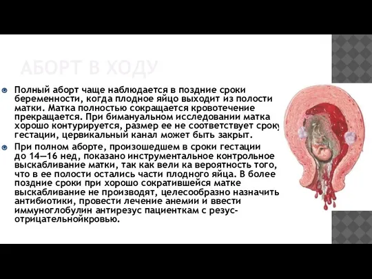 АБОРТ В ХОДУ Полный аборт чаще наблюдается в поздние сроки беременности, когда