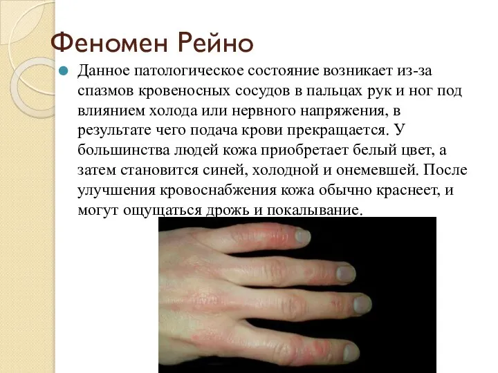 Феномен Рейно Данное патологическое состояние возникает из-за спазмов кровеносных сосудов в пальцах