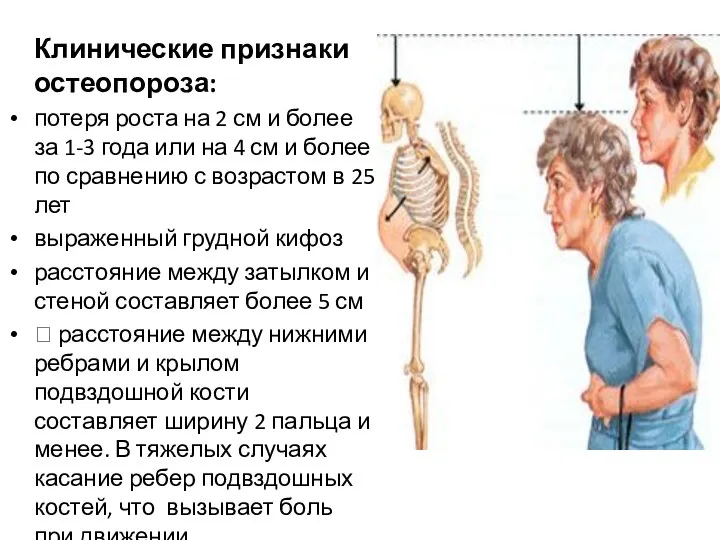 Клинические признаки остеопороза: потеря роста на 2 см и более за 1-3