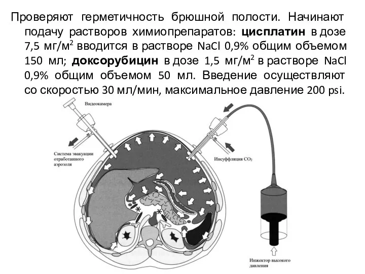 Проверяют герметичность брюшной полости. Начинают подачу растворов химиопрепаратов: цисплатин в дозе 7,5