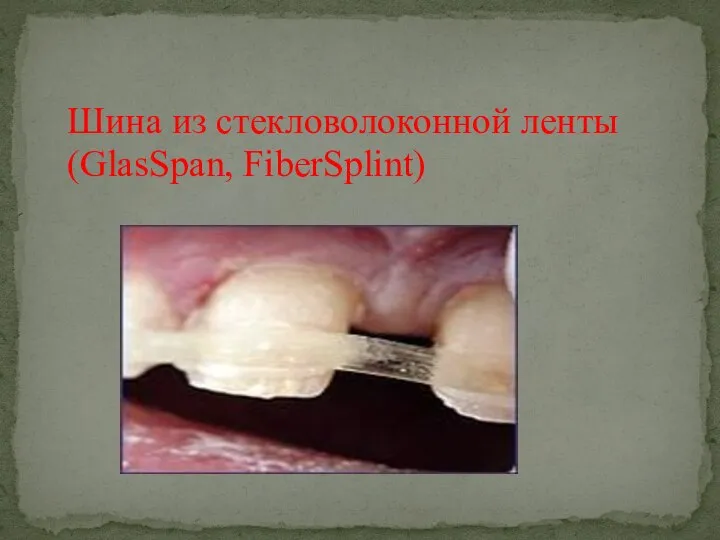 Шина из стекловолоконной ленты (GlasSpan, FiberSplint)