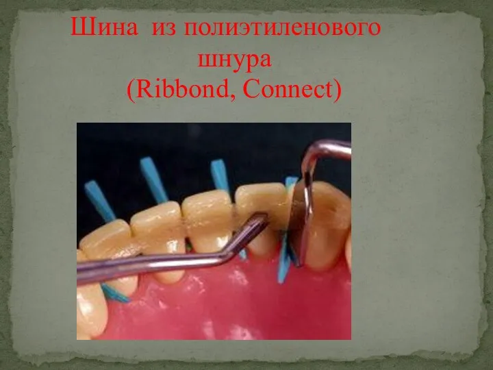 Шина из полиэтиленового шнура (Ribbond, Connect)