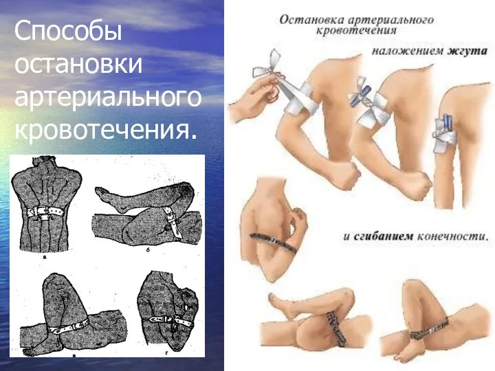 Способы остановки артериального кровотечения.