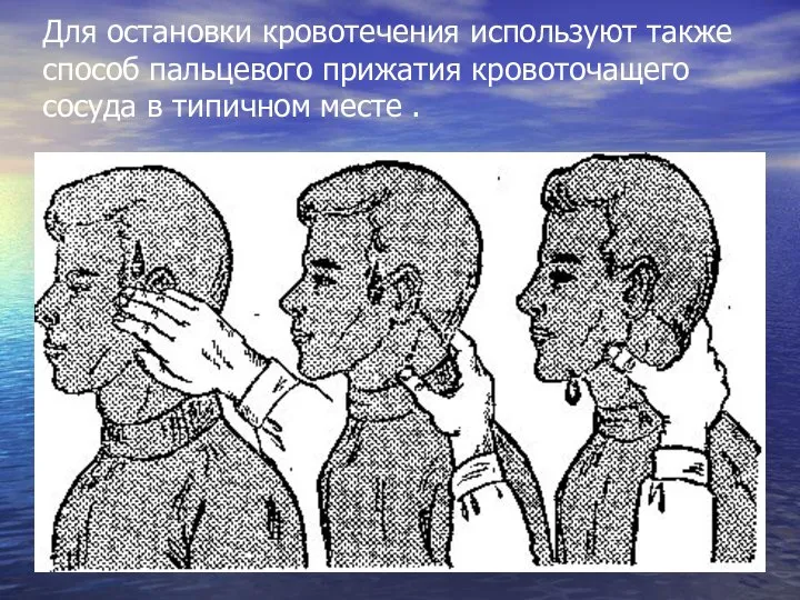 Для остановки кровотечения используют также способ пальцевого прижатия кровоточащего сосуда в типичном месте .