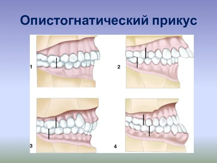 Опистогнатический прикус