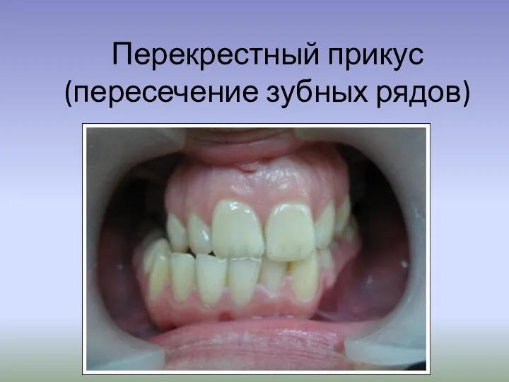 Перекрестный прикус (пересечение зубных рядов)