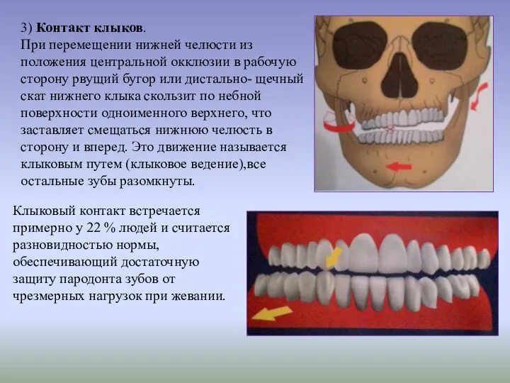 3) Контакт клыков. При перемещении нижней челюсти из положения центральной окклюзии в