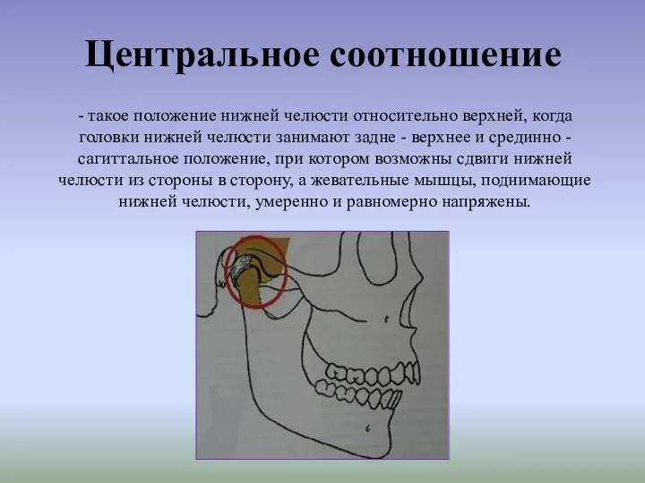 Центральное соотношение - такое положение нижней челюсти относительно верхней, когда головки нижней