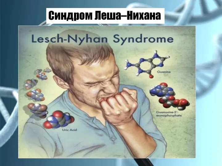 Синдром Леша–Нихана