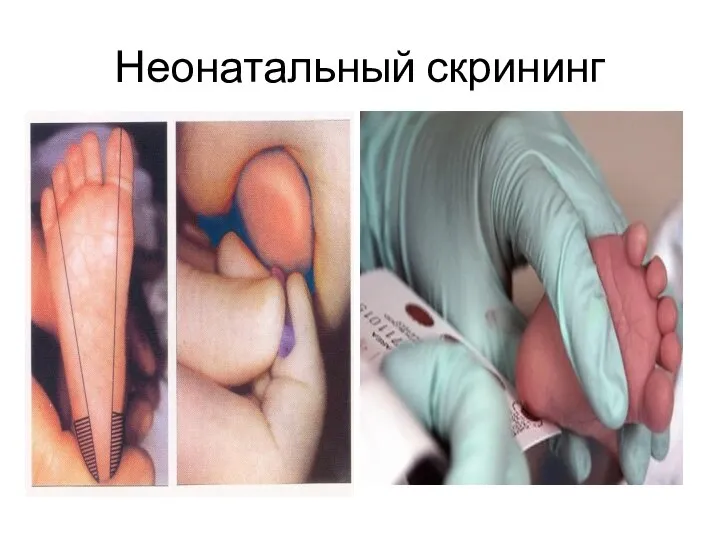 Неонатальный скрининг