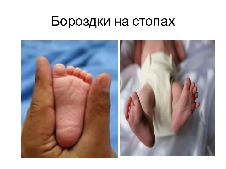 Бороздки на стопах